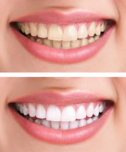 Teeth Whitening Blackburn